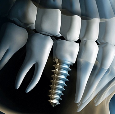 Calgary Dental Implants | Northern Hills Dental | NW Calgary, AB