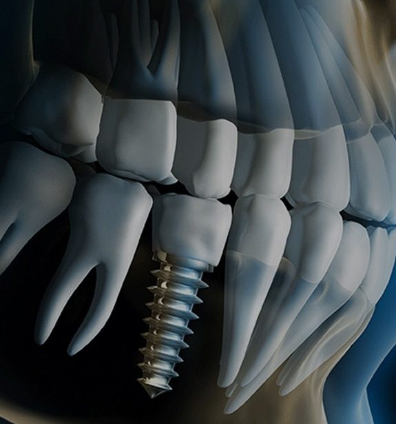 dental-implants-img