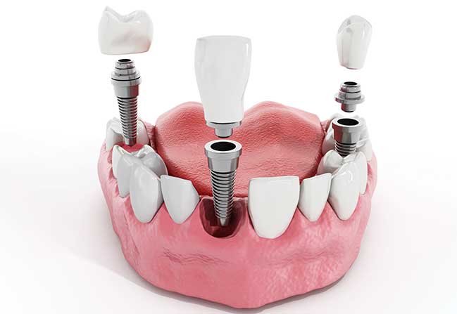 Dental Implants | North Calgary Dentist | Northern Hills Dental