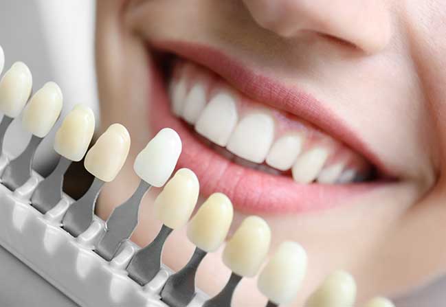 Porcelain Veneers | North Calgary Dentist | Northern Hills Dental