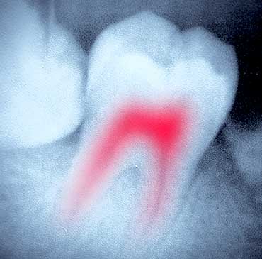 Root Canal Therapy | North Calgary Dentist | Northern Hills Dental