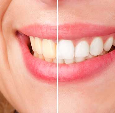 Teeth Whitening | North Calgary Dentist | Northern Hills Dental