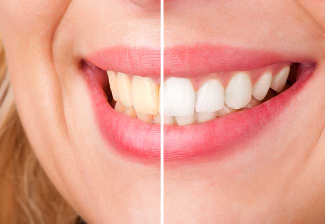 Calgary Teeth Whitening | North Calgary Dentist | Northern Hills Dental