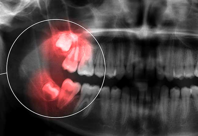 Impacted Wisdom Teeth | North Calgary Dentist | Northern Hills Dental | NW Calgary, AB